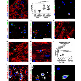 Atrial myxomas arise from multipotent cardiac stem cells